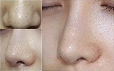 为什么皮肤再好的妹子都被黑头和毛孔困扰?