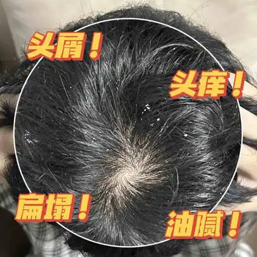 1头皮屑多头皮痒用什么洗头膏?