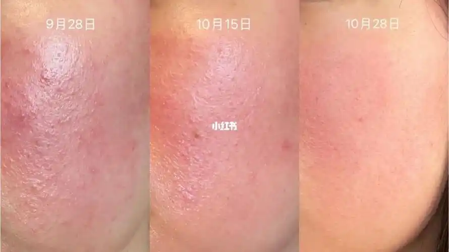 玫瑰痤疮治疗一个月_玫瑰痤疮_皮炎_过敏性皮炎_医疗健康_医疗健康