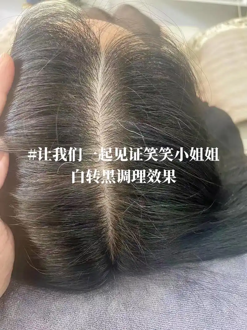 见证笑笑小姐姐白转黑调理.#上热门 笑笑小姐姐从小开始白头发 - 抖音