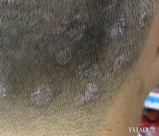 【图】头皮藓图片分享 盘点其病因及临床表现