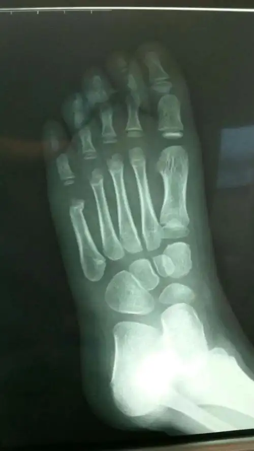 6岁 女 左足第五跖骨远端骨折