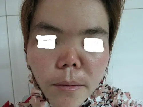 【讨论】这个binder综合症的患者鼻延长怎么做? [病例帖]