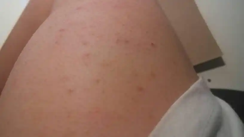 我也有,就是毛囊炎,毛囊堵塞了,不好治哦,不是大问题就是影响美观,我