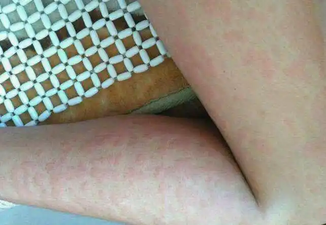 比如,有的人一运动或身体发热,就会全身瘙痒,这是胆碱能性荨麻疹的