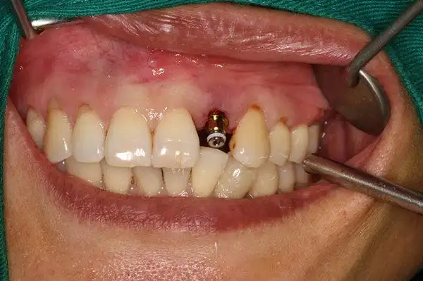 种植牙和我的真牙一样