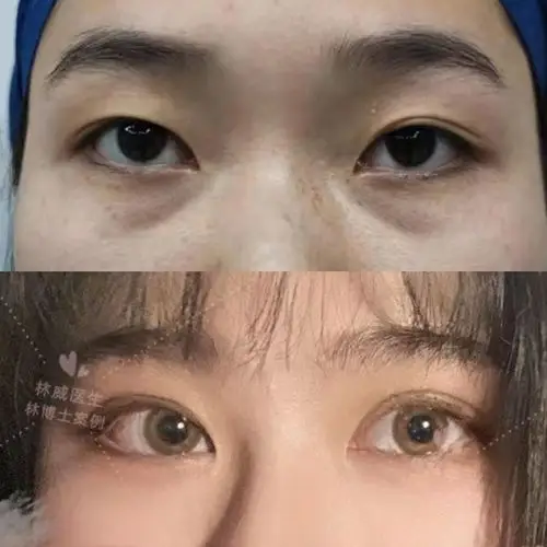 双眼皮提肌对比这个就比较明显了