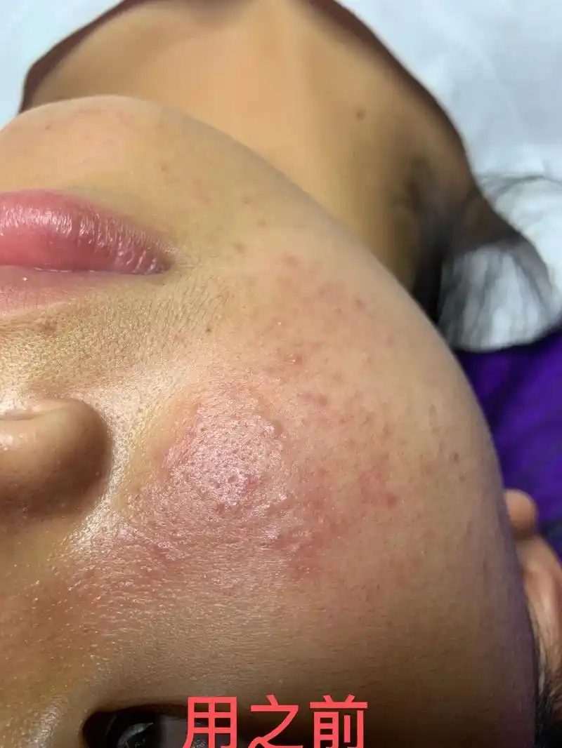 解决任何皮肤问题 #只要你来我就让你变美 #痘痘黑头粉刺拜 - 抖音