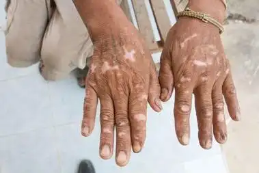 白斑病如何治疗?认准这几点,帮助患者更好地摆脱疾病