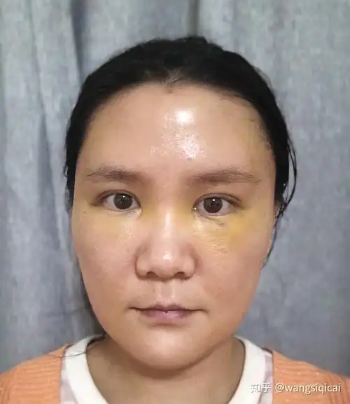 持续更新:80后老阿姨面部脂肪填充日记-快速消肿期—真实猪头照,术后