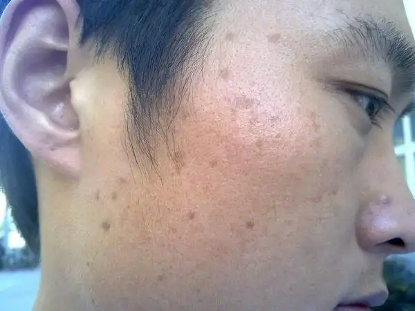 我的脸上长的什么斑?图!