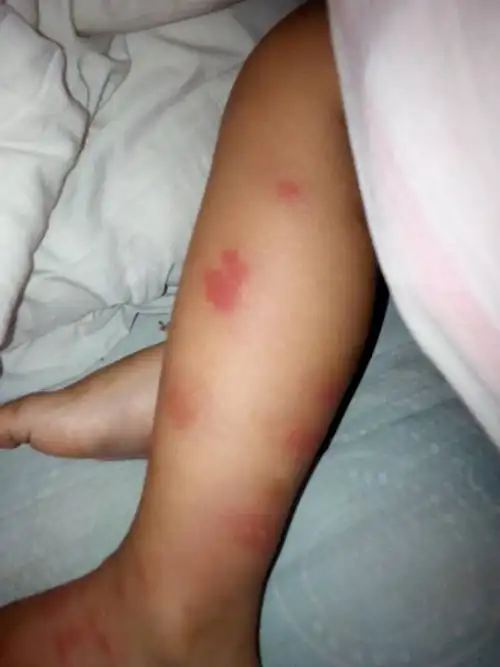 请问孩子身上起的是什么?经常性的!