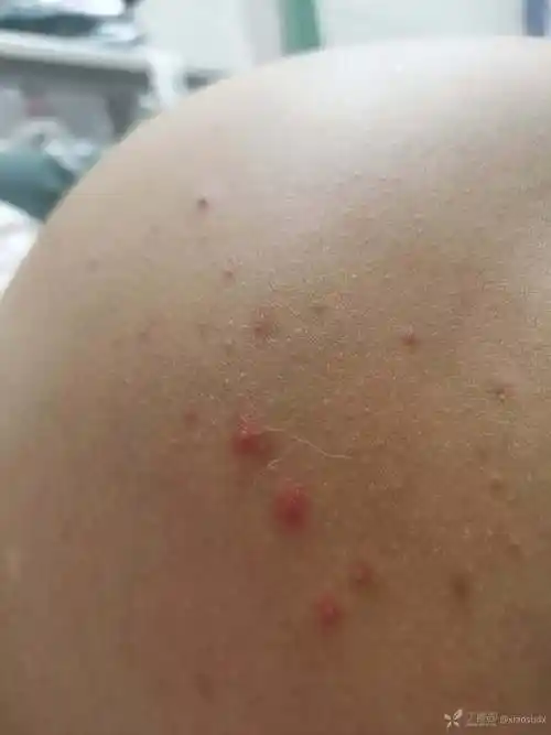 孕妇腹背部毛囊炎求助