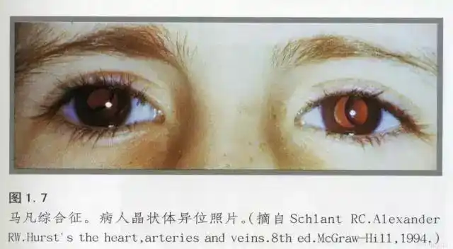 马凡氏综合征从面容上能看出来吗(天才体型后面的隐患)(11)