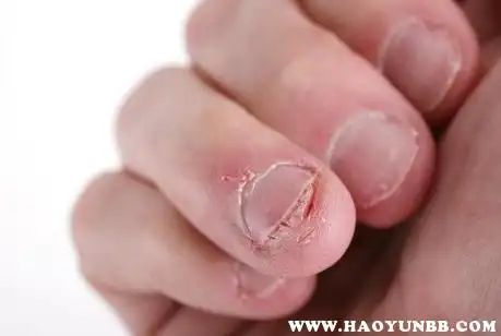 咬指甲后果严重图片长期咬指甲的手会变成什么样