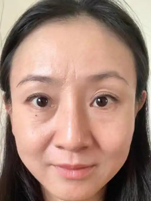 我脸上有很多小细纹一直想去掉,和朋友商量了一下准备_圈子-新氧美容