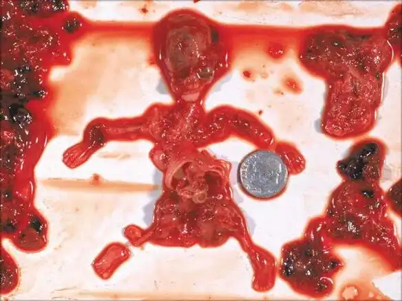 3) 早期堕胎:9周大的胎儿