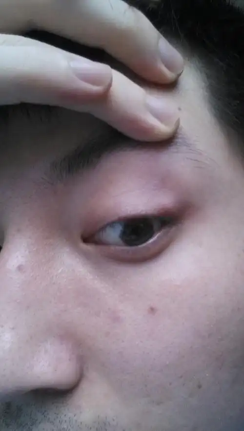 三周前发现眼睛上方眼皮处有一个肿包当时网上查了一下应该是散