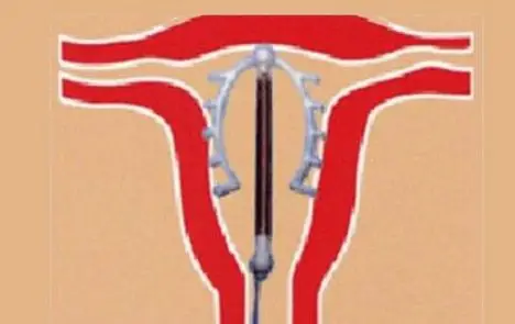 器是一种放置在子宫腔内的避孕装置,由于初期使用的装置多是环状的