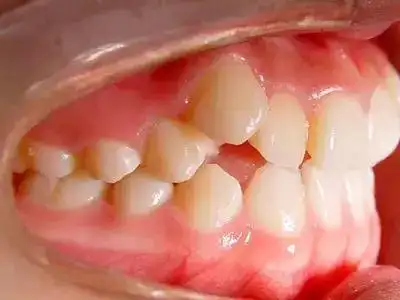 唇侧错位的尖牙