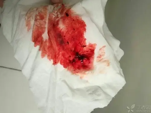 排卵期出血(已锁帖,患者咨询请微信搜索公众号:来问医生(id:laiwenyi