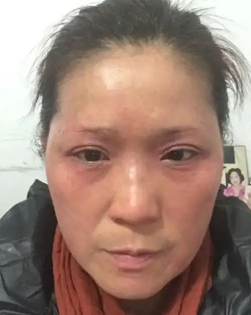 什么是激素依赖性皮炎,你有没有中招呢