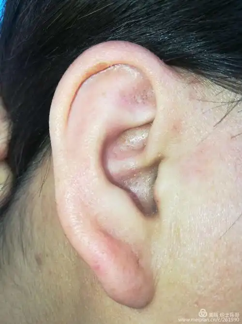 宋士斌耳穴望诊临床图集(3)待续中