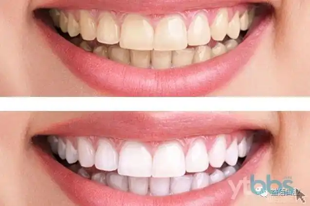 4)最新的陶瓷牙贴面材料与自然牙齿有十分类似的光学性质,修复后的