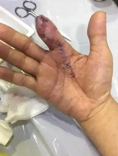 网传清理生虾被刺伤导致截肢!一起来看看什么情况!