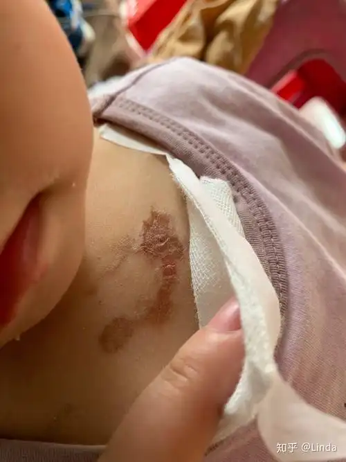 一岁半女儿轻二度烫伤全过程记录