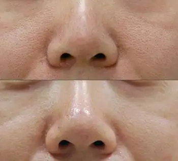 皮肤粗糙的原因主要是因为皮脂过度分泌导致毛孔粗大.