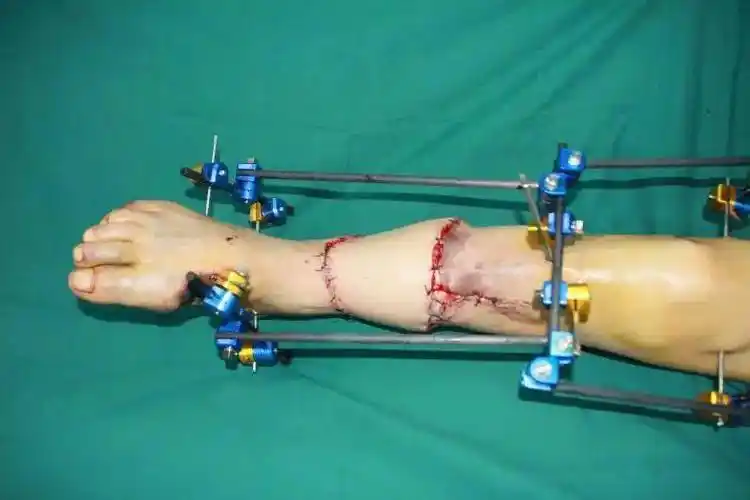 14小时3大难题!小腿完全离断后,成功再植!_王先生_手术_断肢