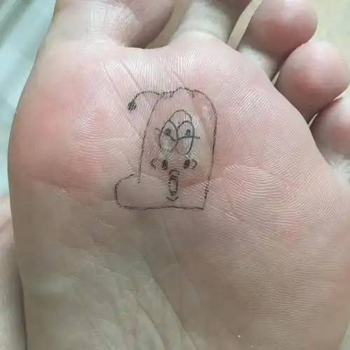 这是洗澡脚底板被水泡发了的样子割掉的以后找了一张网上跖疣的图