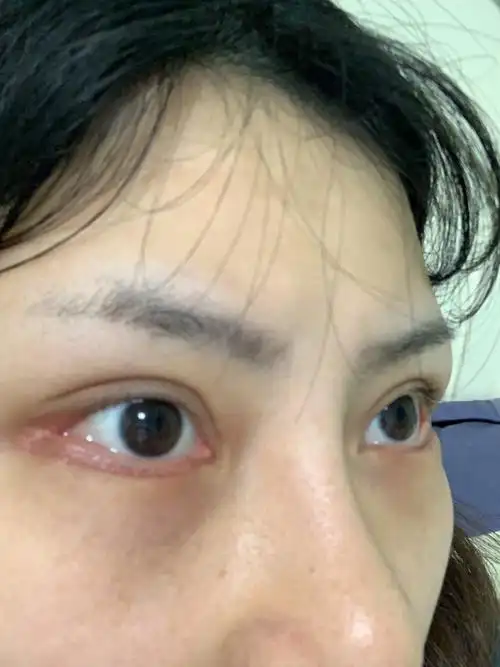 我做了眼睑下至开外眼角是不是做失败了现在两眼不对称一只眼睛是三角