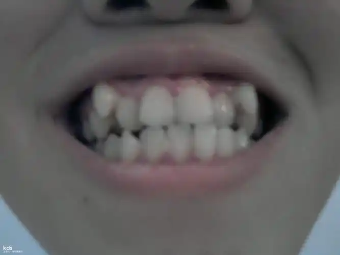 [android]什么叫老虎牙,是叠牙吗