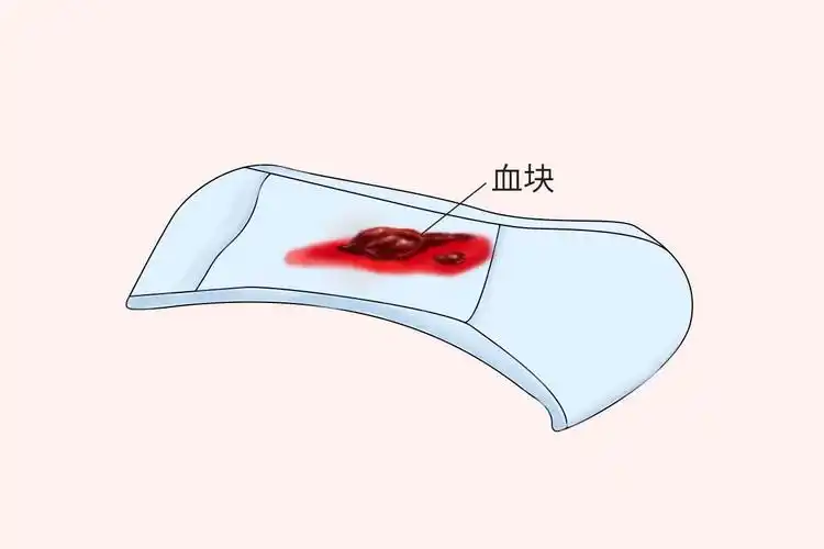 宫颈癌的患者一般是由于癌肿出现逐渐增大的现象,会侵袭周围组织血管