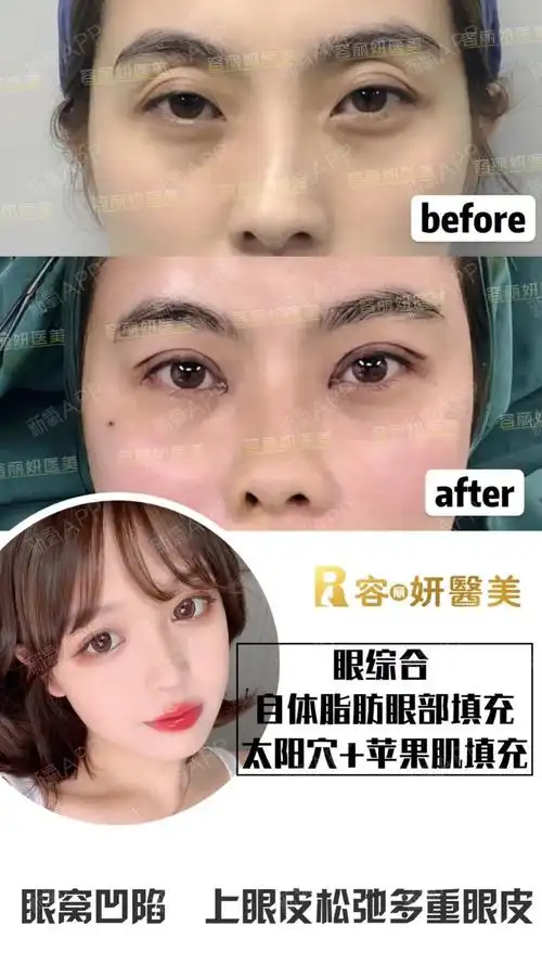 眼部多项 自体脂肪眼部填充