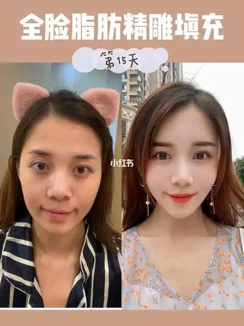 全脸脂肪胶精雕填充第15天真实记录