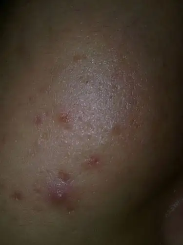 这是属于什么痘痘我经常熬夜 19岁 好了会留下红色的印 有的还留下小