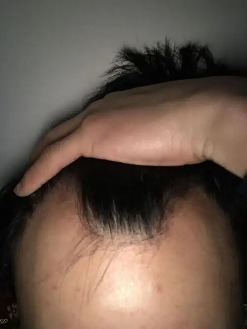 头发两边没有头发怎么办,用生姜有用吗?