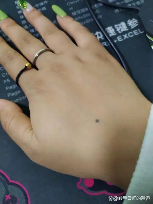 右手背有痣代表什么 1,手背上的痣是大吉大利之痣,代表主人会赚钱和