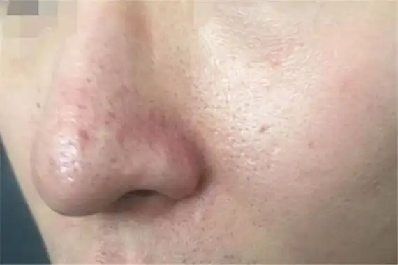 鼻子毛孔粗大小妙招-排行榜123网