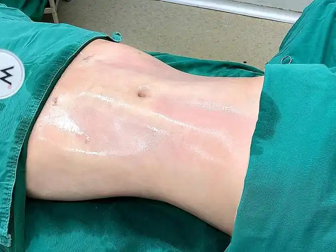 图片腹部脂雕马甲线精雕腹部吸脂图片马甲线脂雕马甲线 手术人鱼线