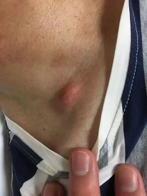 【医生提醒】容易误诊的皮肤淋巴瘤(内含高能预警图片)