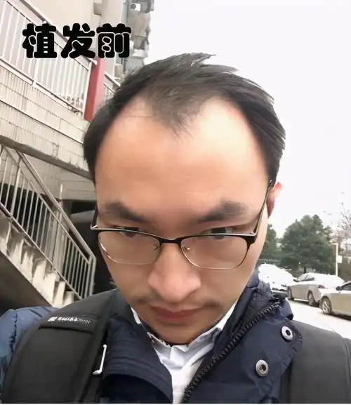 男生发际线高是一种什么样的体验脱发用药和植发有效果吗