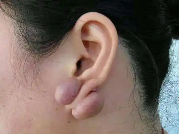 耳廓瘢痕疙瘩.jpg