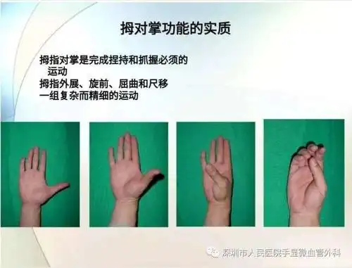 探索小肌肉移植重建拇对掌功能的研究中我们经历了哪些呢?