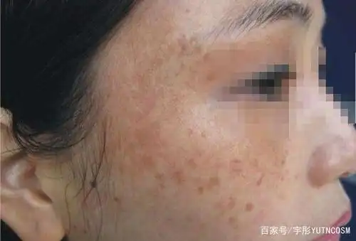 面部长斑,该怎么定制皮肤管理?
