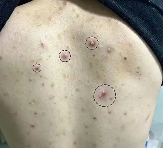 用对沐浴露!螨虫背,痘痘洗洗就掉!_皮肤_效果_泡沫