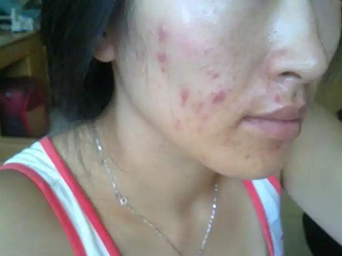 美容师教你1绝招,坚持就还你无暇肌肤|痘印|肌肤|痘痘_新浪新闻